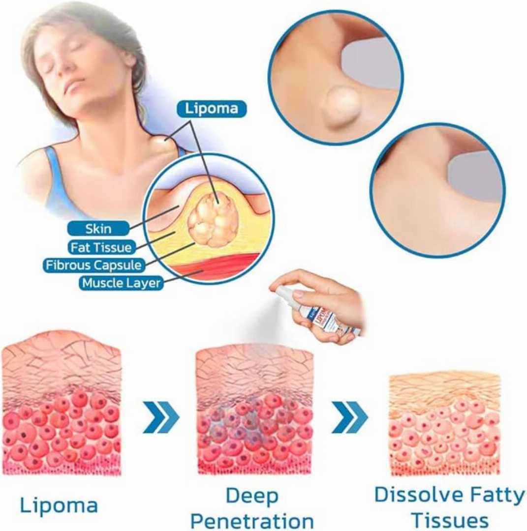 Lipoma,Remover,Spray,Relief,Lipolysis,Fat,Lump,With,Lipoma,Spray,