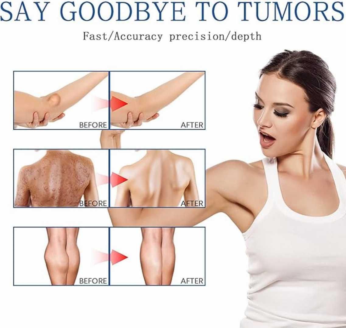 Lipoma,Remover,Spray,Relief,Lipolysis,Fat,Lump,With,Lipoma,Spray,